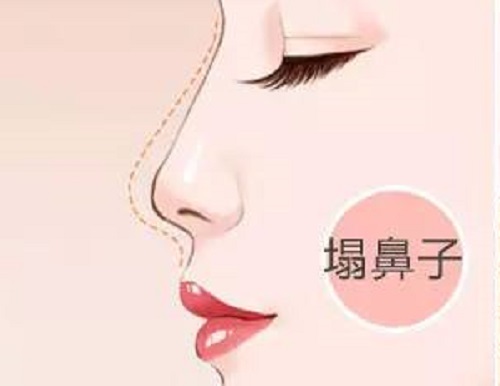 塌鼻梁面相分析:为您揭秘塌鼻梁人的性格与一生运势!
