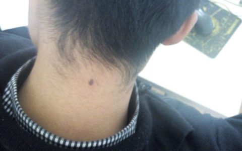 脖子上有痣的男人代表什么 脖颈上右侧有长痣代表什么