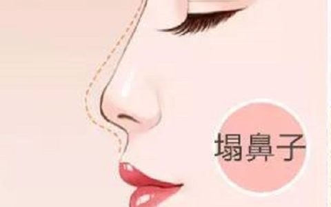 塌鼻梁面相分析：为您揭秘塌鼻梁人的性格与一生运势！