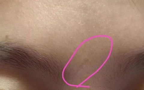 印堂有疤痕的男人命运